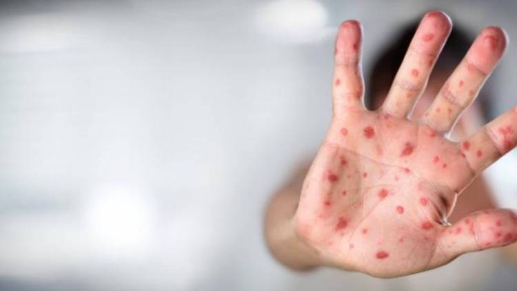 Viruela del mono: Francia y Alemania confirman sus primeros casos